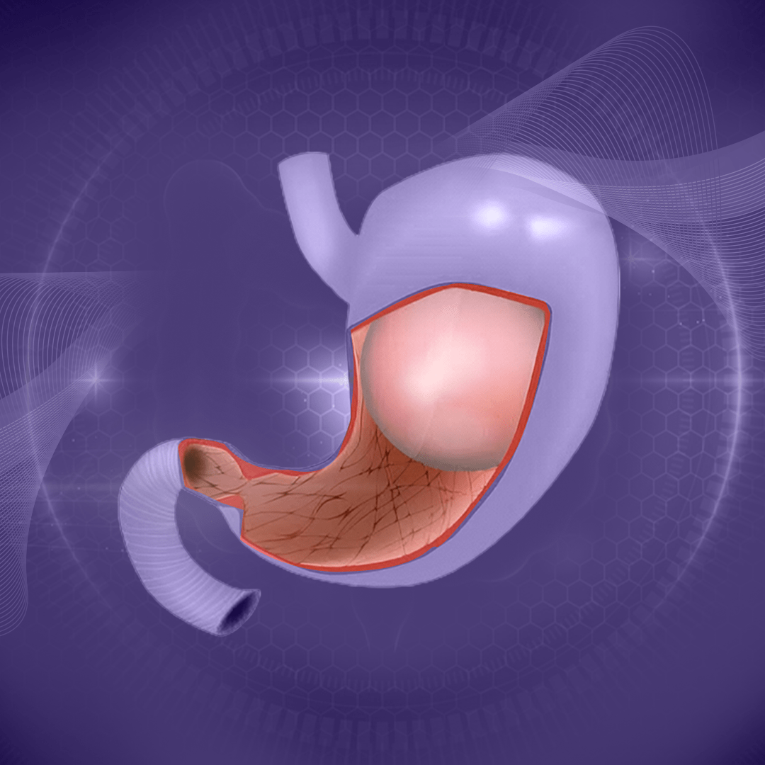 Gastric Balloon - Dr. Mohamed AL kady