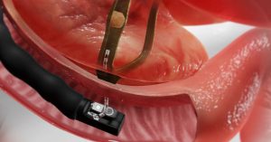 Endoscopic Retrograde Cholangiopancreatography (ERCP)